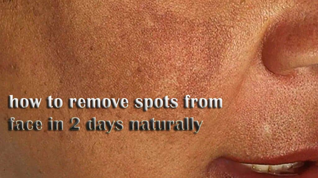 how to remove spots from face in 2 days naturally